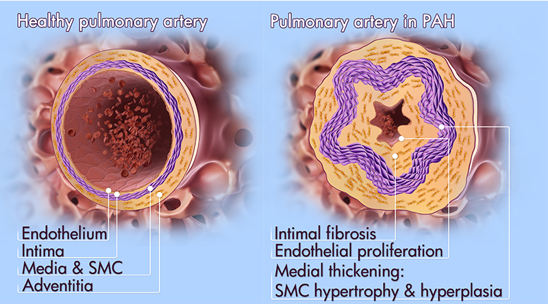 What Happens to the Pulmonary Arteries